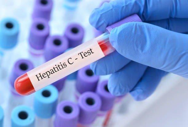 HEPATITIS C VIRUS - IGG